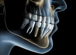 Capacitação Protético em Implantes Osseointegrados