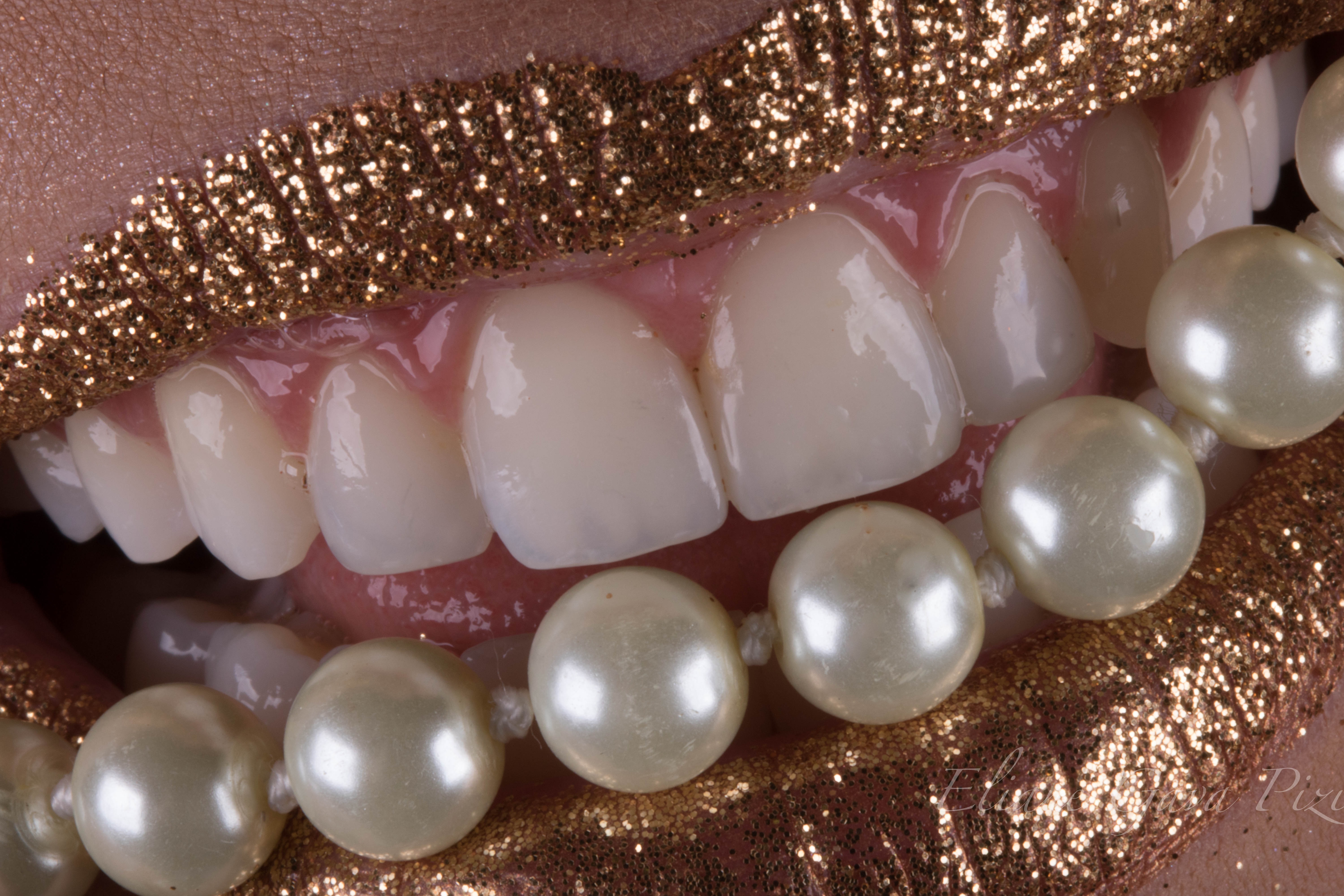 Estética e função na reabilitação direta de dentes anteriores