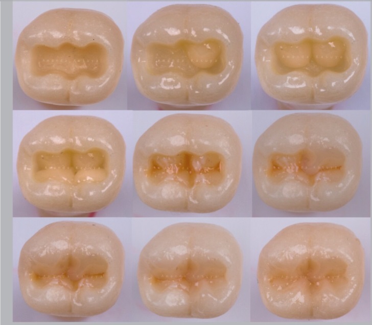Curso de Imersão em Resinas Compostas Posterior