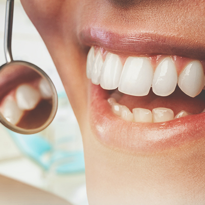 Imersão em resinas compostas para dentes anteriores - Aplicação dos conceitos de cor e forma aos proced. restauradores diretos