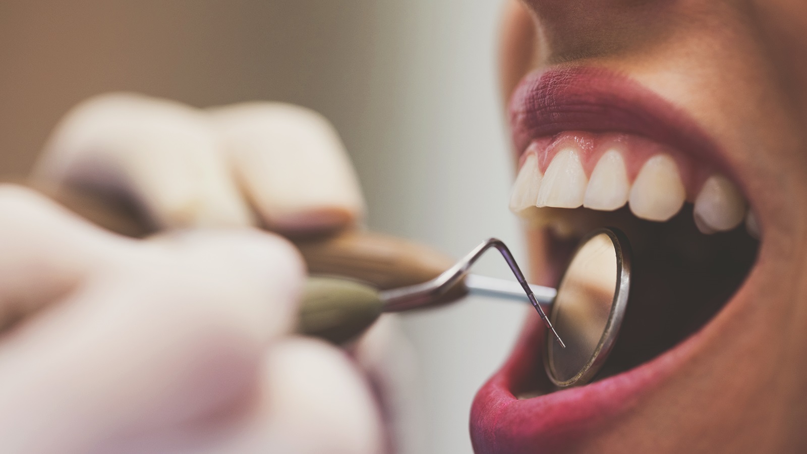 Resinas Compostas - A escultura lapidando a oclusão de dentes posteriores.