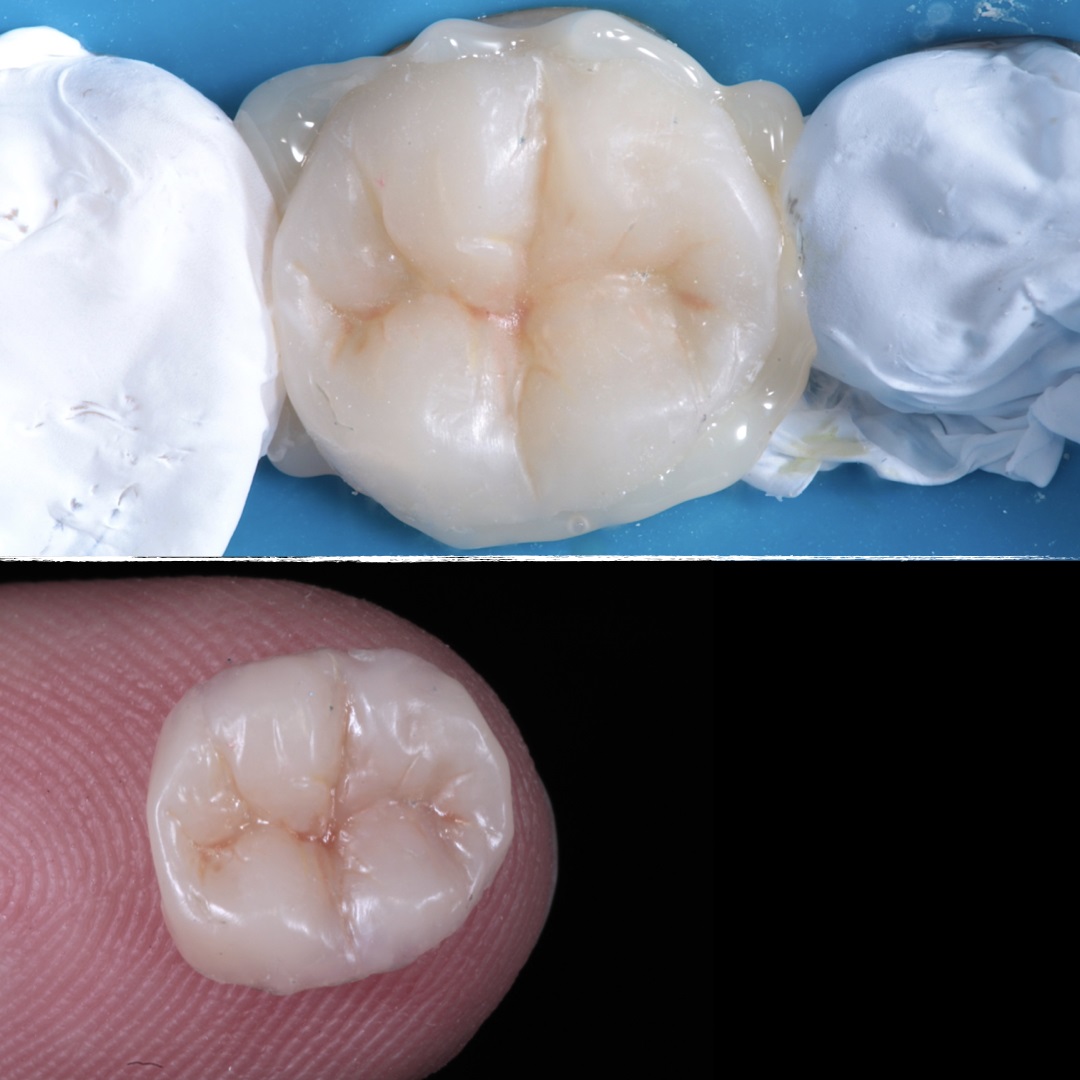 Atualização em restaurações adesivas indiretas: conceitos atuais para o tratamento estético e funcional de dentes posteriores                                                                                                                                  